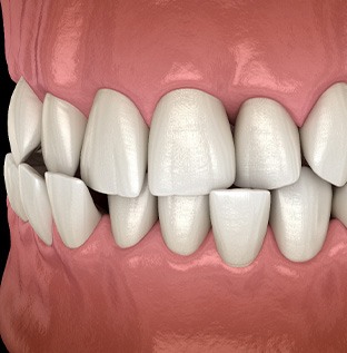 Illustration of a crossbite