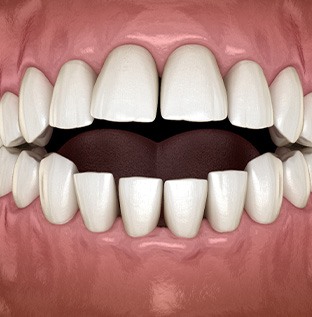 Illustration of an open bite