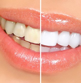Before and after teeth whitening