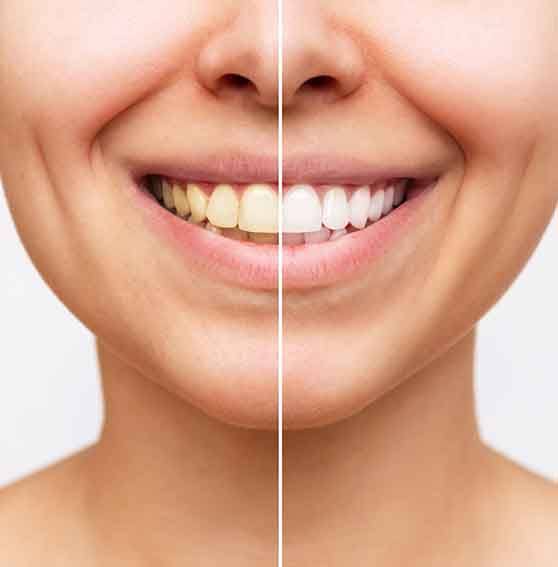 Closeup of woman's smile before and after teeth whitening