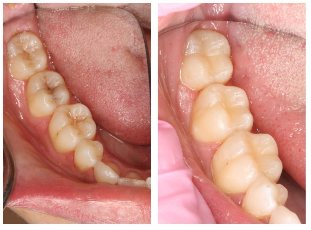 Treating Cavities In Kittanning Dental Crowns Voller Dentistry